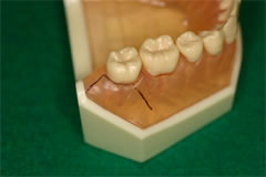 下顎水平埋伏抜歯の際の切開腺①