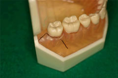 上顎埋伏智歯抜歯の際の切開線①