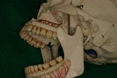 上顎埋伏智歯抜歯の際の切開線②