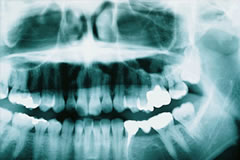 上顎埋伏智歯の抜歯①