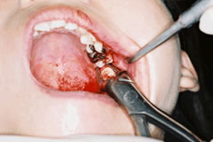 上顎埋伏智歯の抜歯⑥