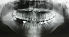 歯牙移植術の実際①