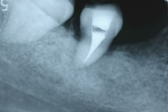 歯牙移植術の実際⑦
