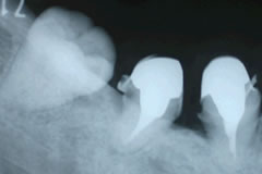 歯牙移植術の実際⑩