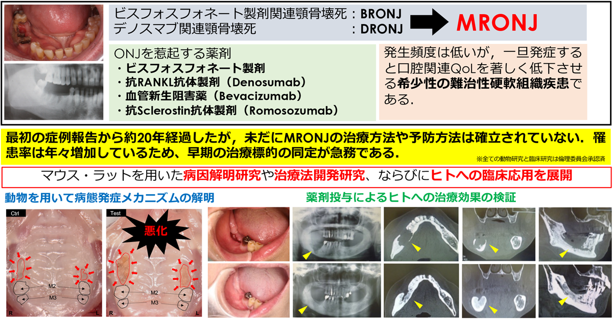 顎骨壊死(MRONJ)の原因究明と治療方法の開発