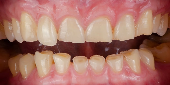 Tooth wearのイメージ