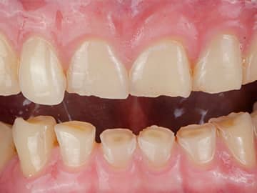 Tooth wearのイメージ